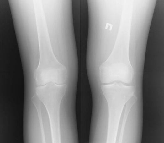 Belauneko artikulazioaren erradiografia