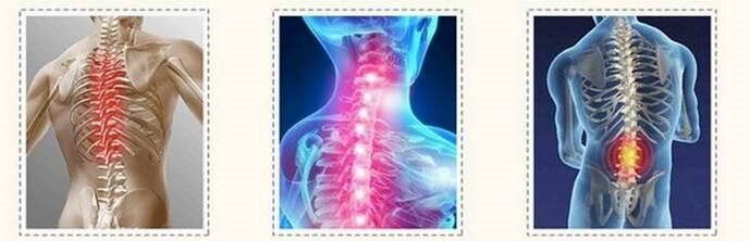 Osteokondrosia bizkarrezurreko lesioak